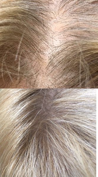 Włosy przestały wypadać po trzecim zabiegu.  