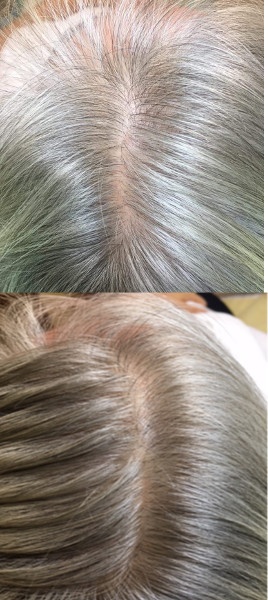 Gęste zdrowe włosy już po czterech zabiegach