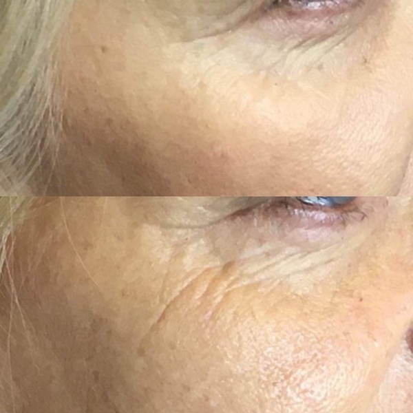 Efekt terapii fibryną bogatopłytkową po czterech zabiegach