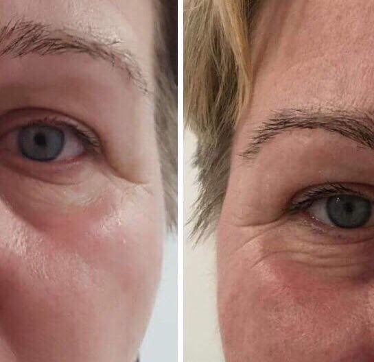 Magia - nie, terapia osoczem bogatopłytkowym!