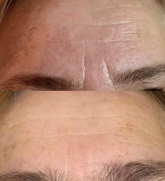 Wygładzenie lwiej zmarszczki