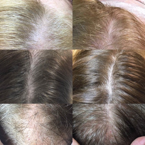 Leczenie łysienia damskiego osoczem bogatopłytkowym