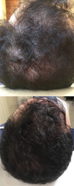 Po zakończonej kuracji 10-ciu zabiegów