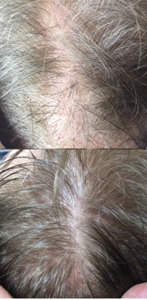 Włosy pacjenta po 5-ciu zabiegach osoczem