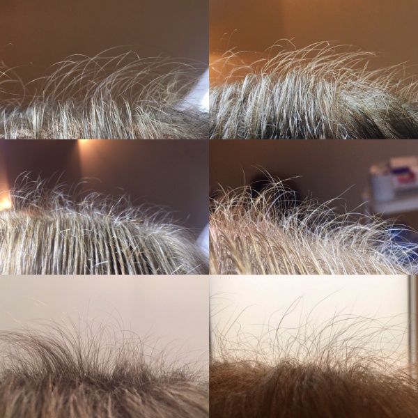 Odrost nowych włosów po kilku zabiegach mezoterapii osoczem.