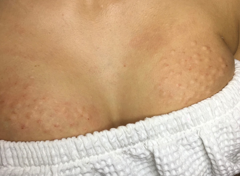 Mezoterapia osoczem bogatopłytkowym rozstępów na piersiach.