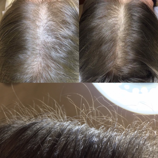 Pacjentka po trzecim zabiegu i 