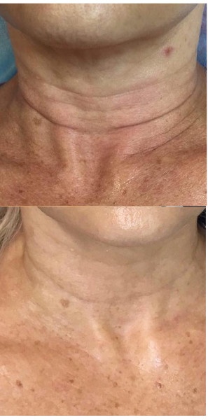 Efekt po 6-ciu zabiegach osoczem bogatopłytkowym