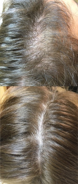 Efekt terapii osoczem po czterech zabiegach