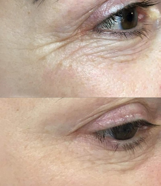 Redukcja zmarszczek - 